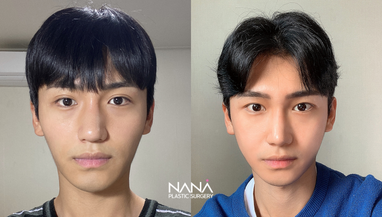 男性整形 症例写真 — 症例写真