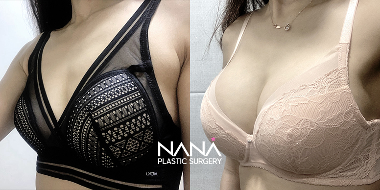 전후사진 전후사진