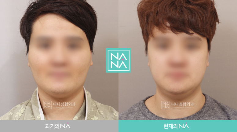 Facial Contouring Before & After — Before & After