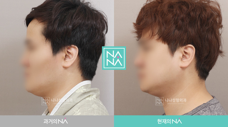 Before & After Before & After