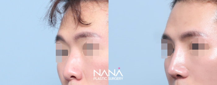 男性整形 症例写真 — 症例写真