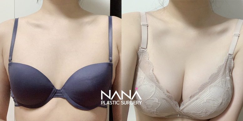 전후사진 전후사진