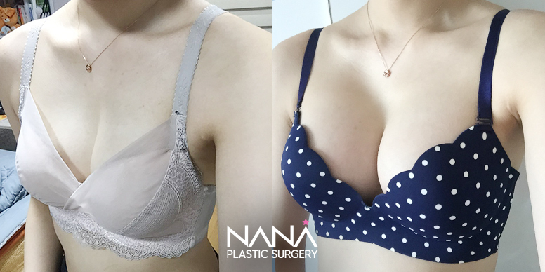 가슴성형 전후사진 — 전후사진