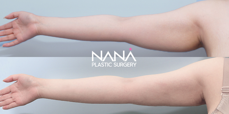 Liposuction Before & After — Before & After