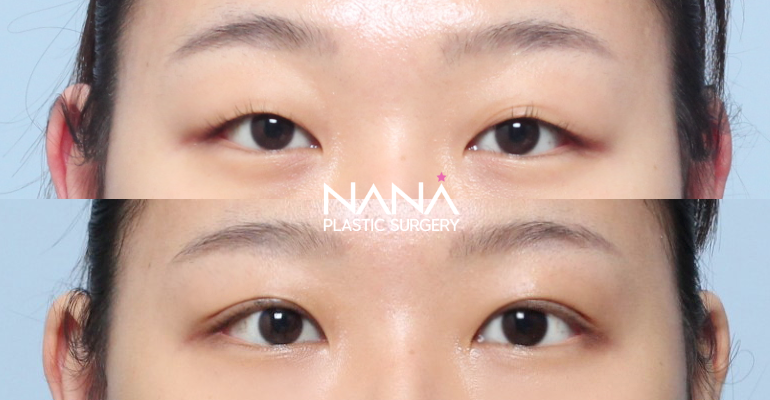 Eyes Before & After — Before & After