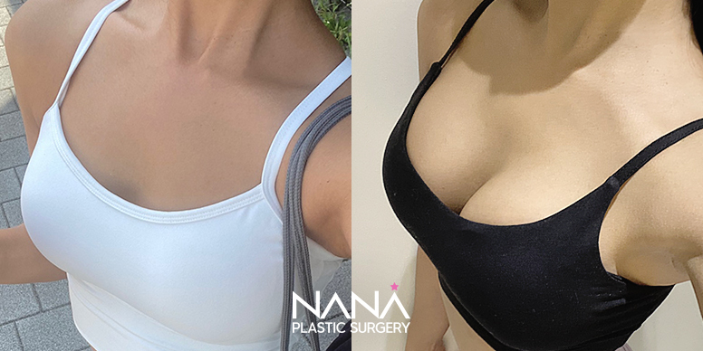 Breast Before & After — Before & After