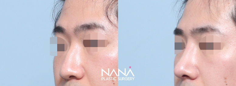 男性整形 症例写真 — 症例写真