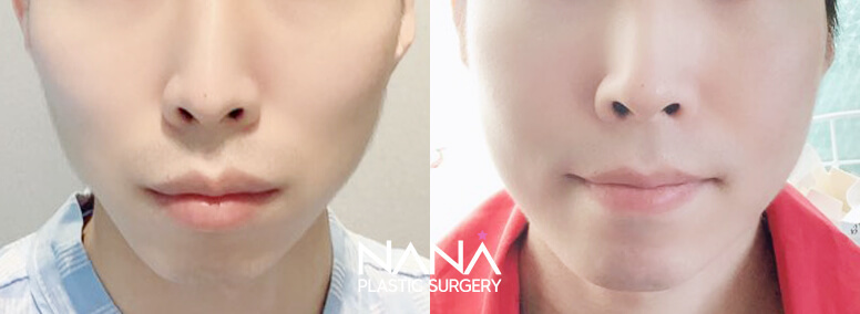 Facial Contouring Before & After — Before & After