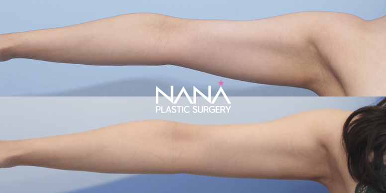 Liposuction Before & After — Before & After