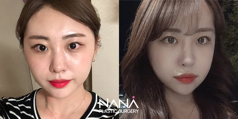 Facial Contouring Before & After — Before & After