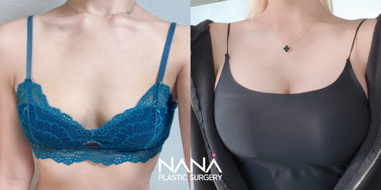 Breast Before & After — Before & After