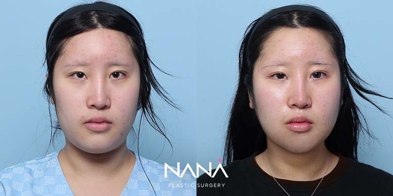 Before & After Before & After