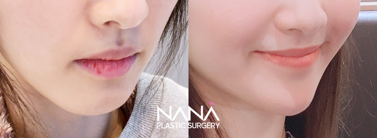 Other Before & After — Before & After