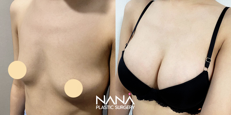Breast Before & After — Before & After