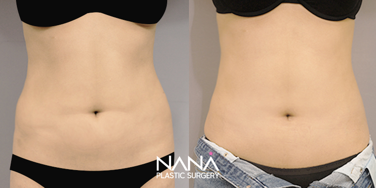 Liposuction Before & After — Before & After
