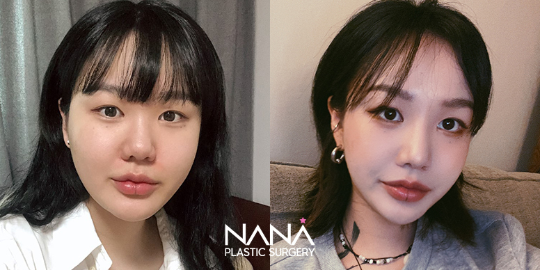 Liposuction Before & After — Before & After