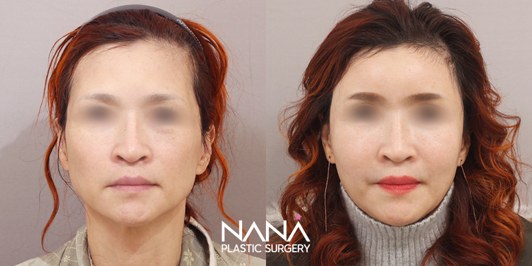 Lifting Before & After — Before & After