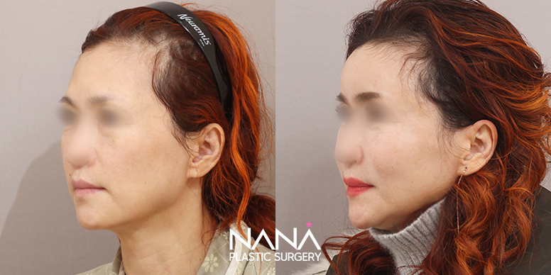 Before & After Before & After