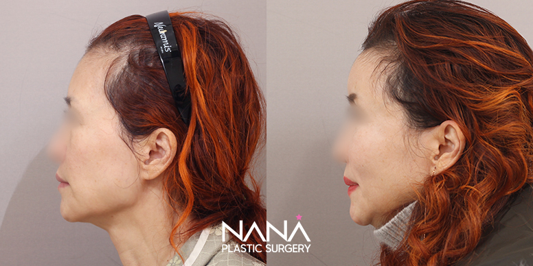 Before & After Before & After