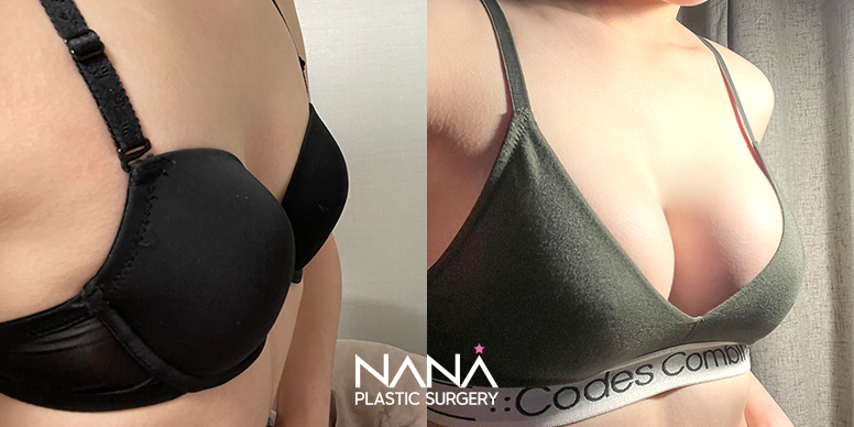 Breast Before & After — Before & After