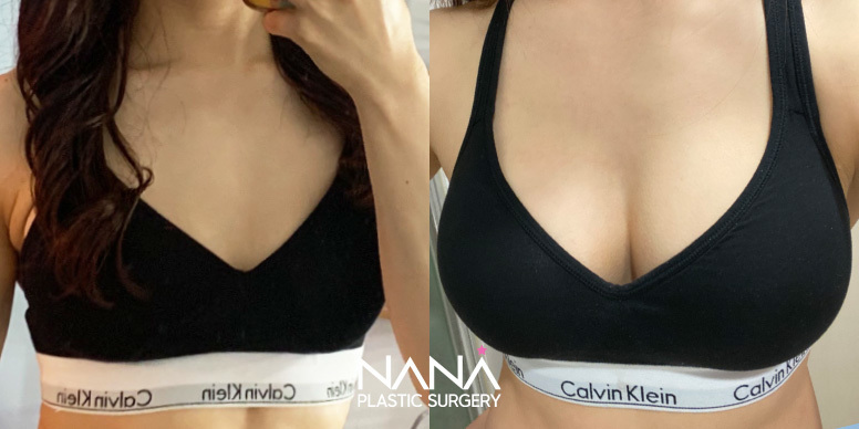 Breast Before & After — Before & After