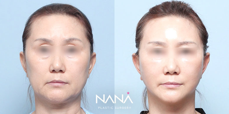 Lifting Before & After — Before & After
