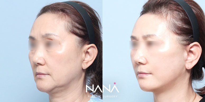 Before & After Before & After