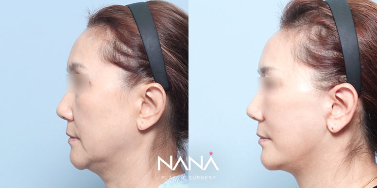 Before & After Before & After