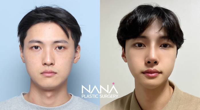 男性整形 症例写真 — 症例写真