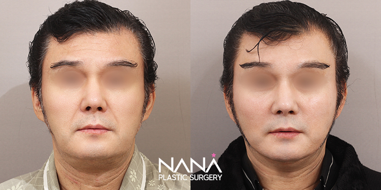 リフティング 症例写真 — 症例写真