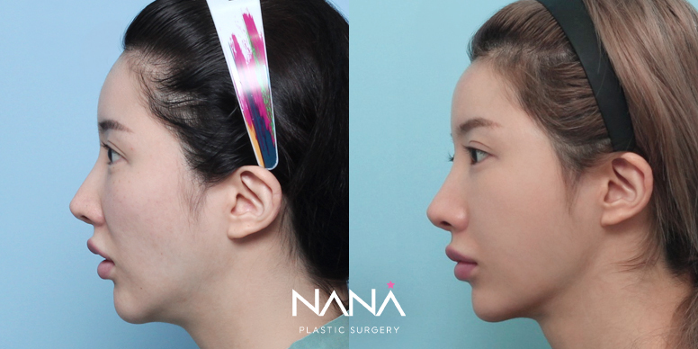 Before & After Before & After