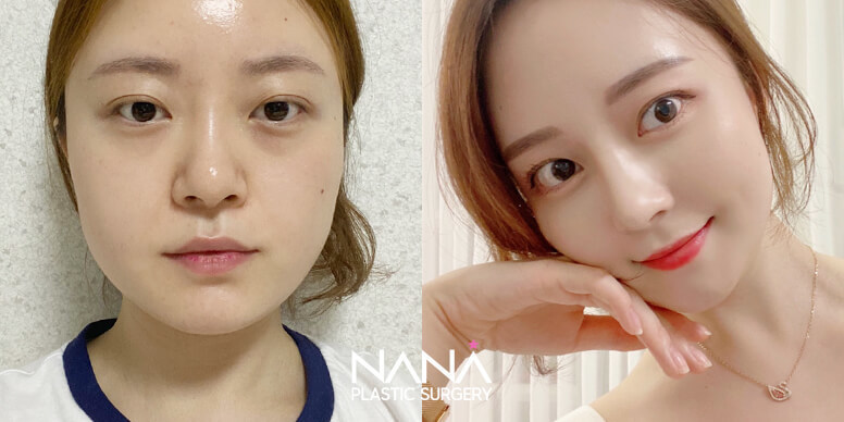Facial Contouring Before & After — Before & After