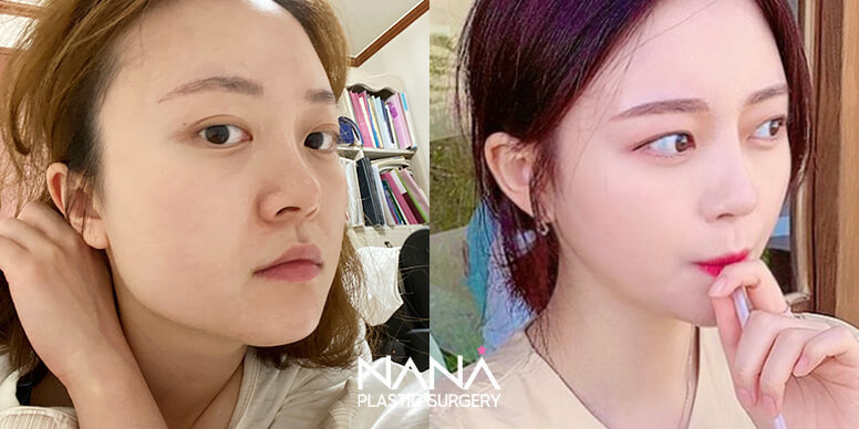 Before & After Before & After