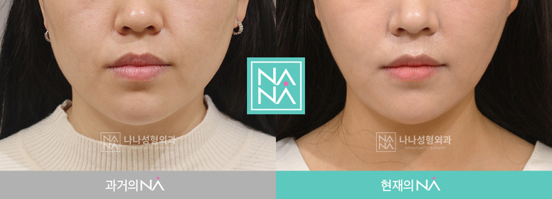 Other Before & After — Before & After