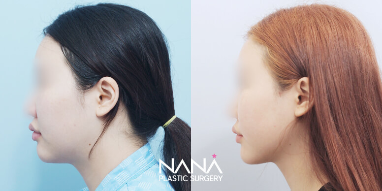 Before & After Before & After