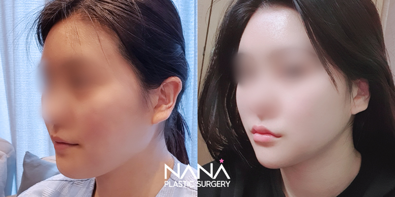 Facial Contouring Before & After — Before & After