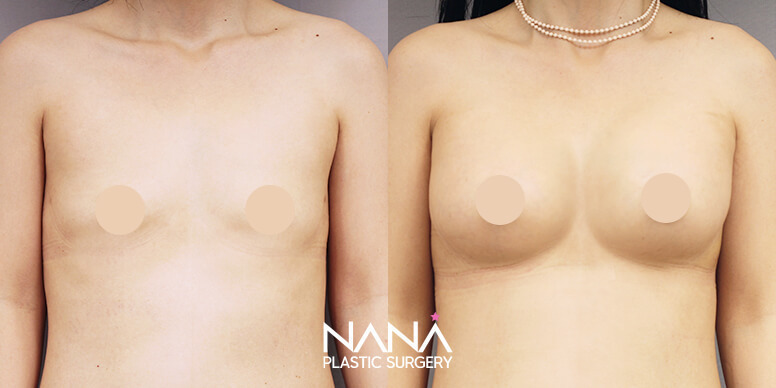 Breast Before & After — Before & After