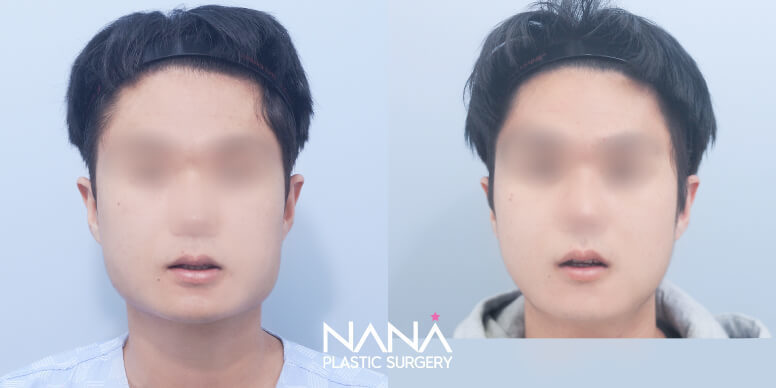 Facial Contouring Before & After — Before & After