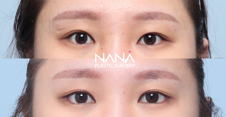 Eyes Before & After — Before & After