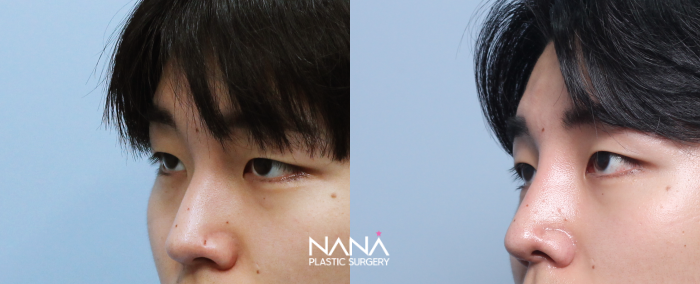 男性整形 症例写真 — 症例写真
