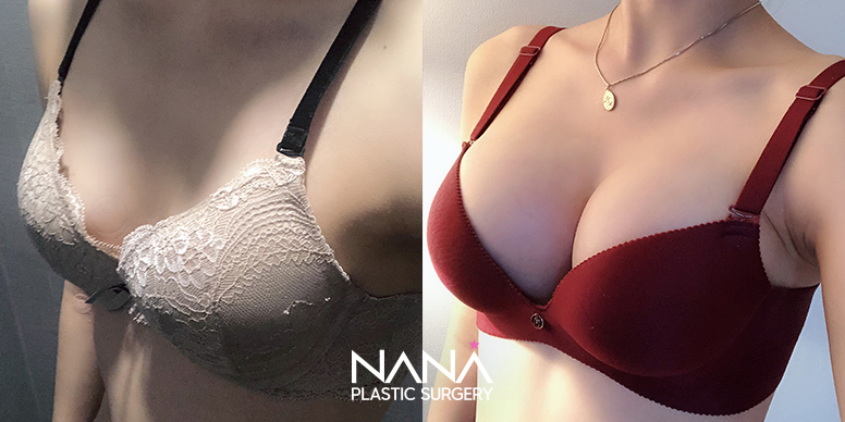Breast Before & After — Before & After