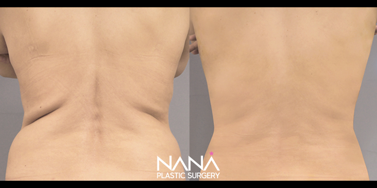 Liposuction Before & After — Before & After