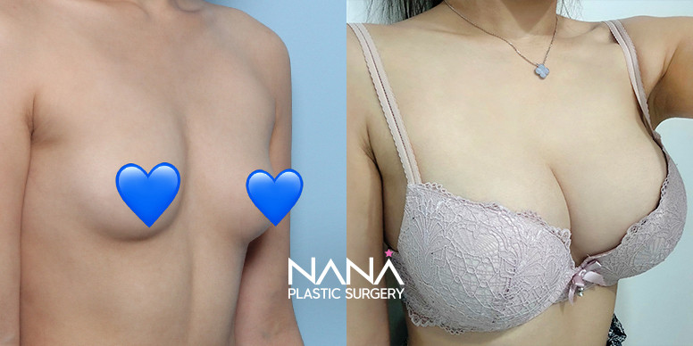 전후사진 전후사진