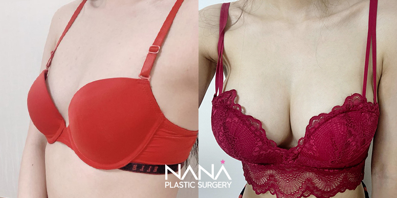전후사진 전후사진