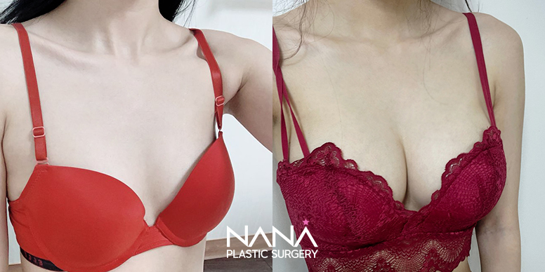 전후사진 전후사진