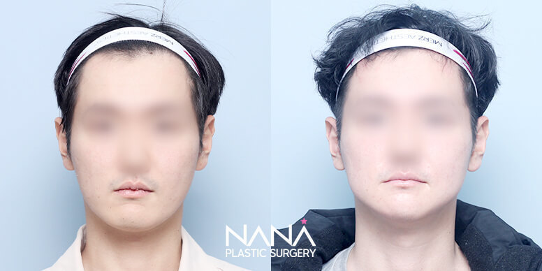 Facial Contouring Before & After — Before & After