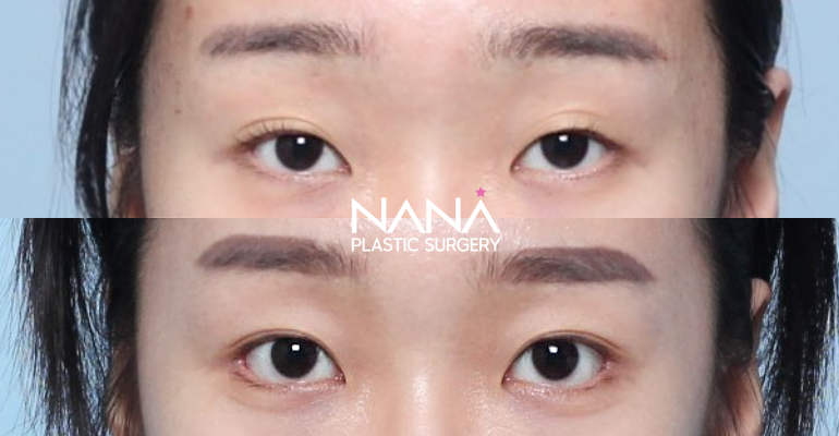 Eyes Before & After — Before & After