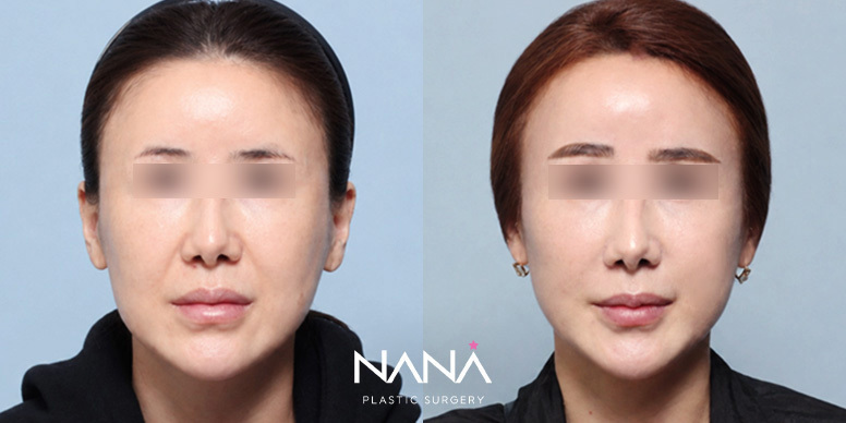 Lifting Before & After — Before & After