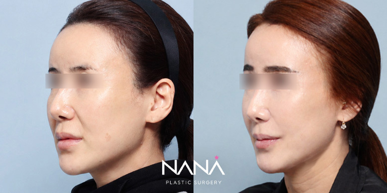 Before & After Before & After