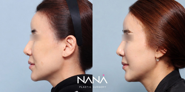 Before & After Before & After